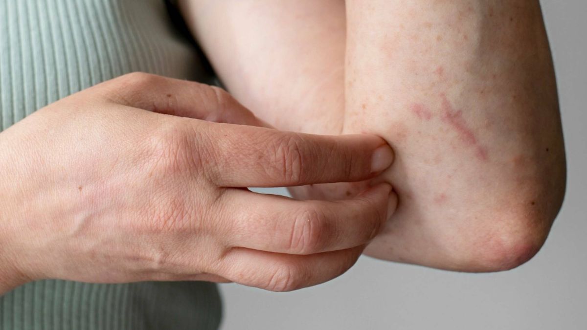 Por qué cada vez hay más niños que tienen dermatitis atópica