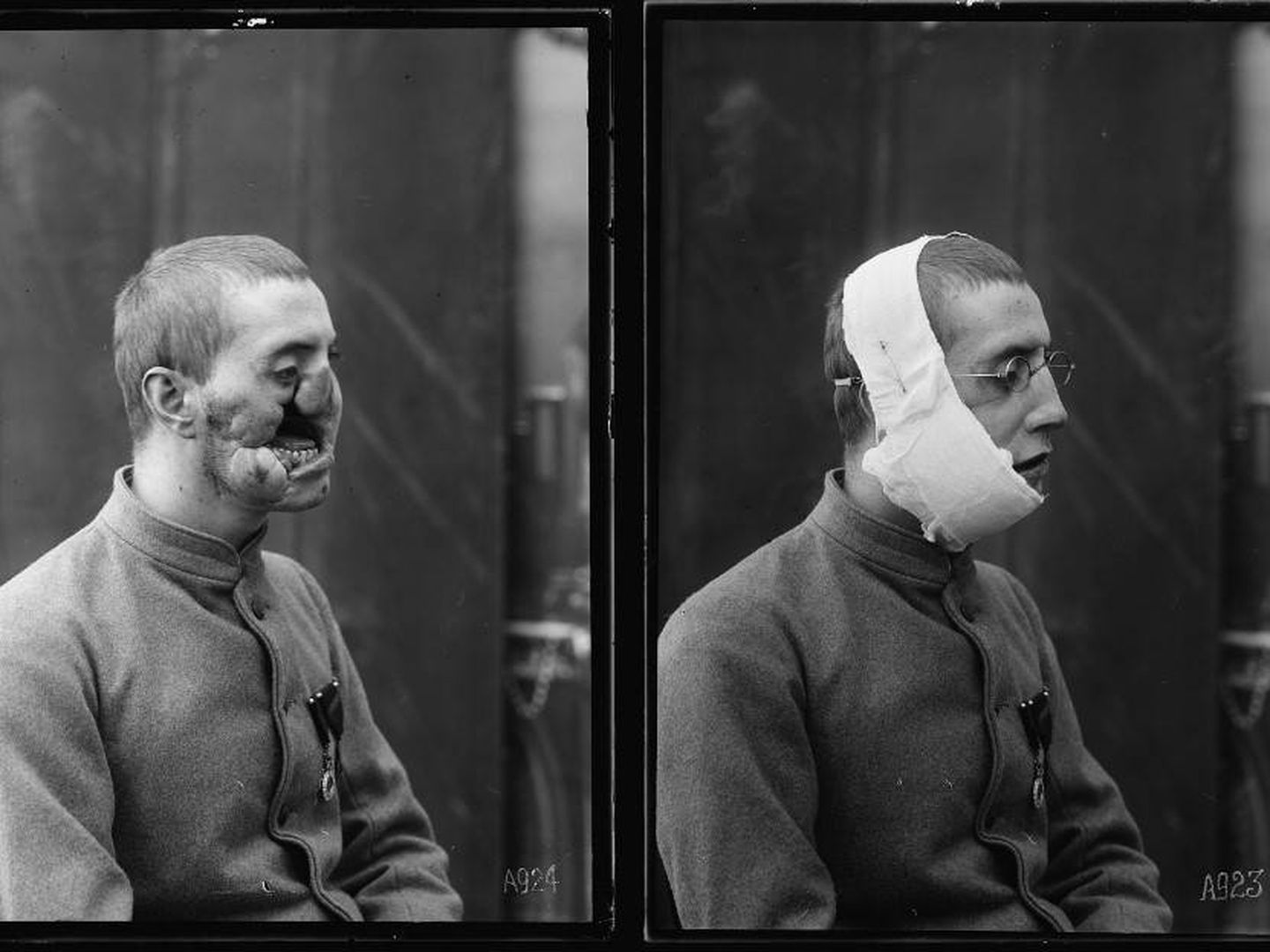 Antes y después de la operación y la colocación de la máscara de Ladd (Library of Congress)