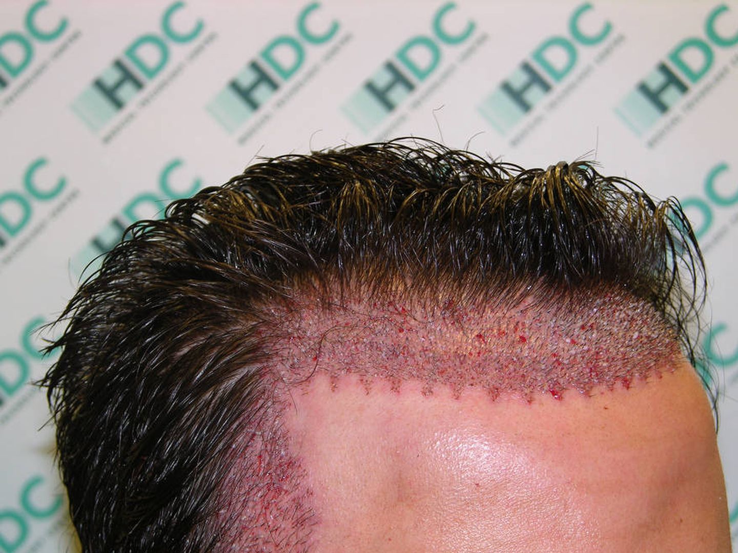 Los trasplantes de pelo son una de las salidas más obvias del nuevo compuesto (Hairtrasplant / Flickr)