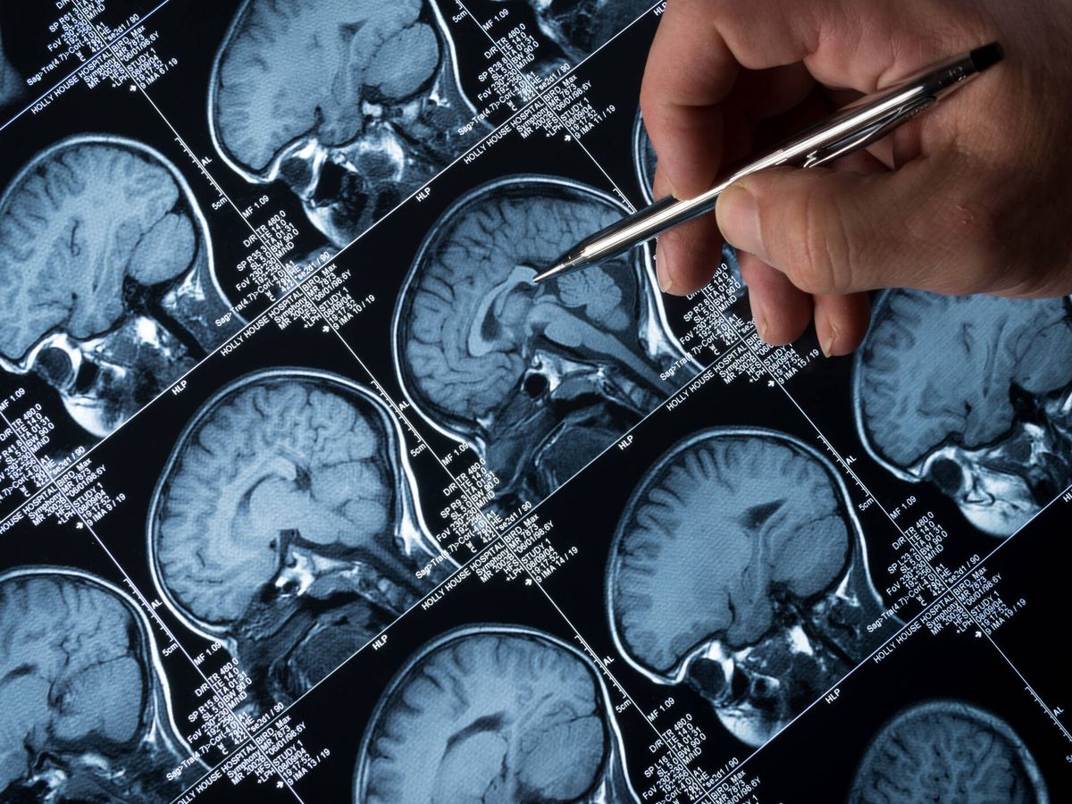 Disfunción eréctil y alzhéimer: ¿más en común de lo que parece?