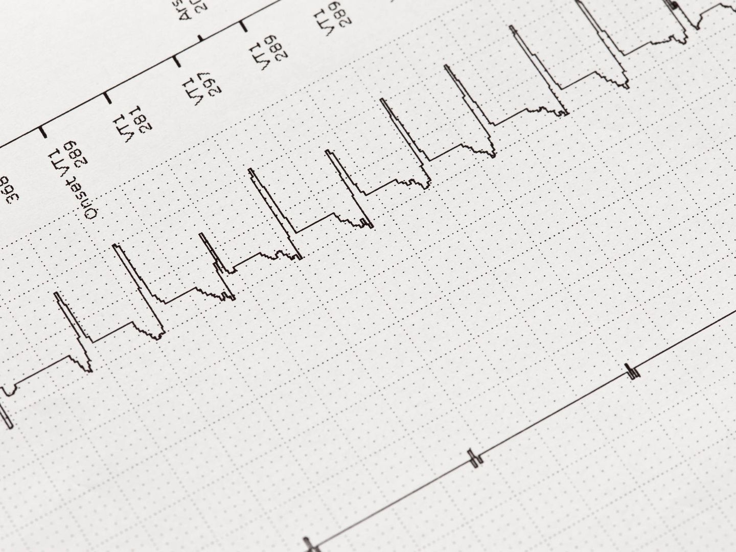 Un electrocardiograma anormal. (iStock)