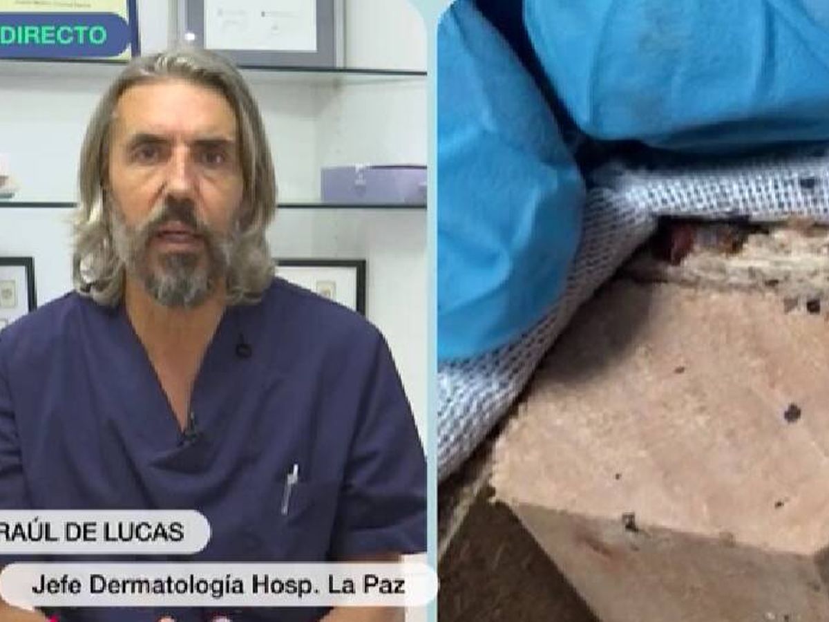 Foto: El jefe de dermatología del Hospital de la Paz explica en 'Más vale tarde' dónde aparecen las chinches.(La Sexta)