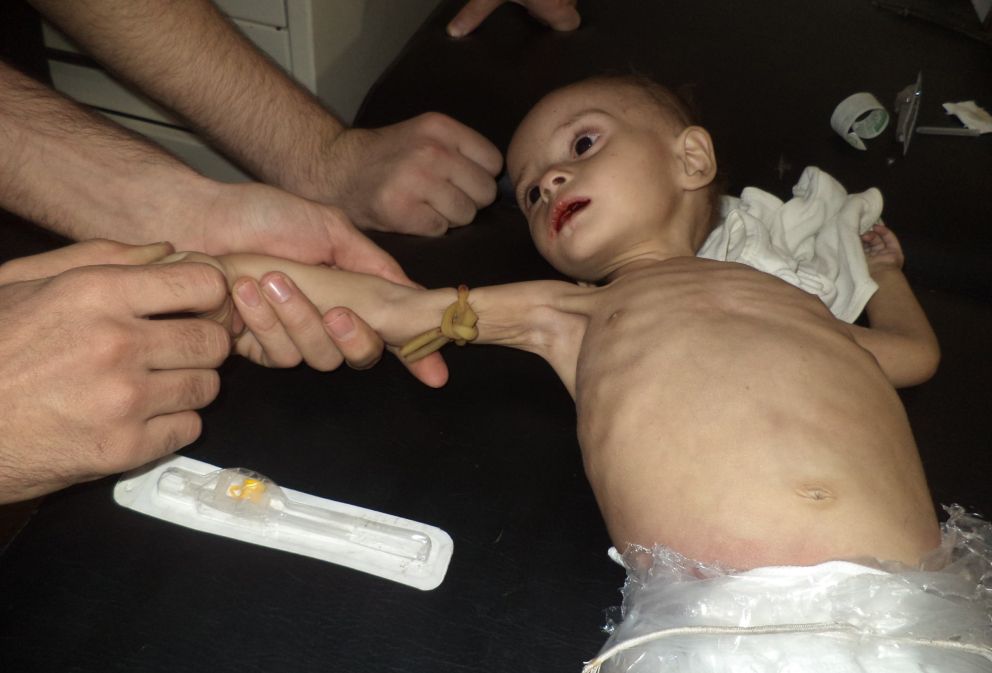 Un niño afectado por una grave desnutrición en Muadamiya (D. al Qappani).