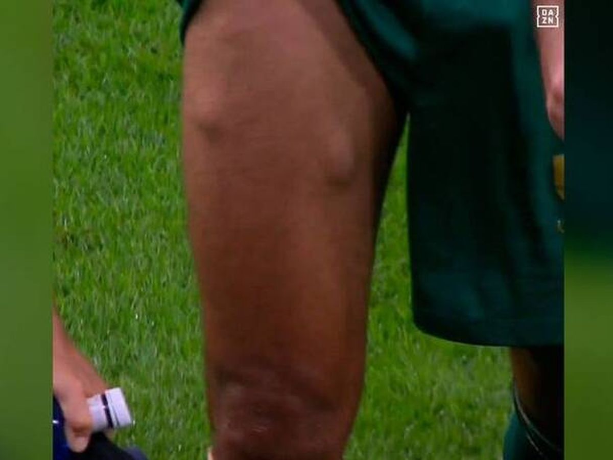 Foto: La pierna de Fali al abandonar el terreno de juego. (DAZN)
