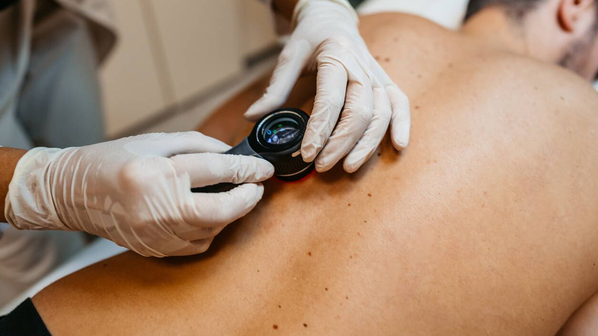 Investigadores españoles desarrollan un nuevo método para detectar el melanoma precozmente