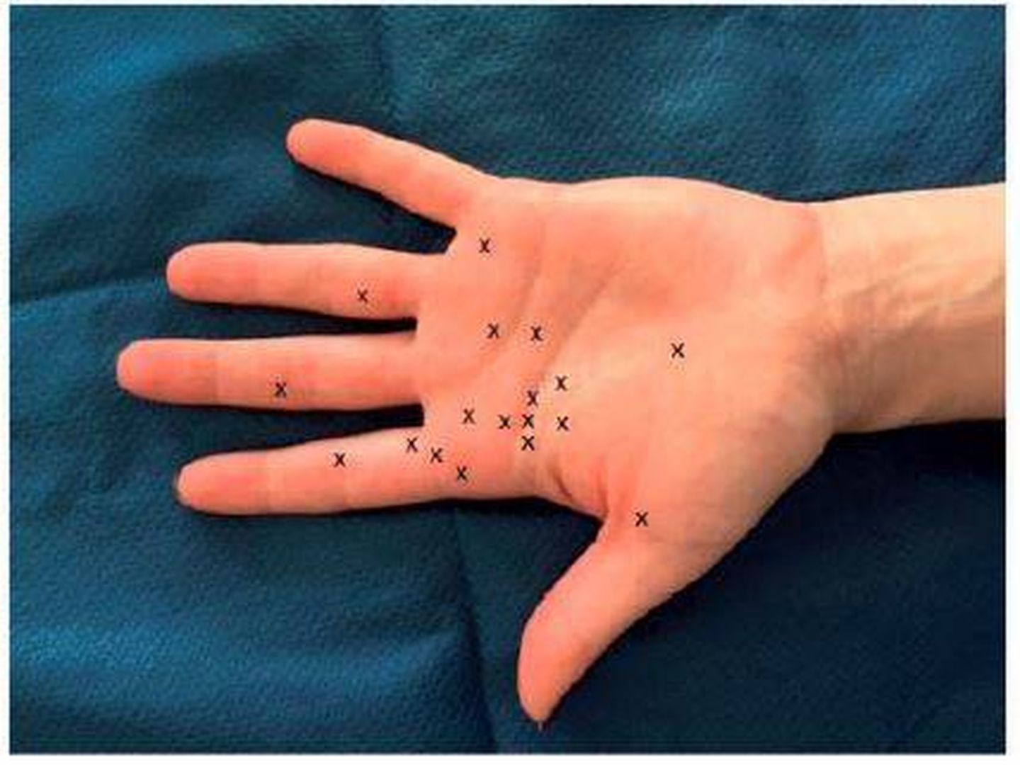 Aquí se produjeron las 18 lesiones al pelar un aguacate (Journal of Hand Surgery)