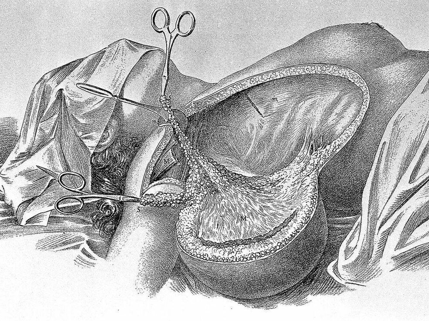 Ilustración de una mastectomía realizada por el médico William Stewart Halsted.
