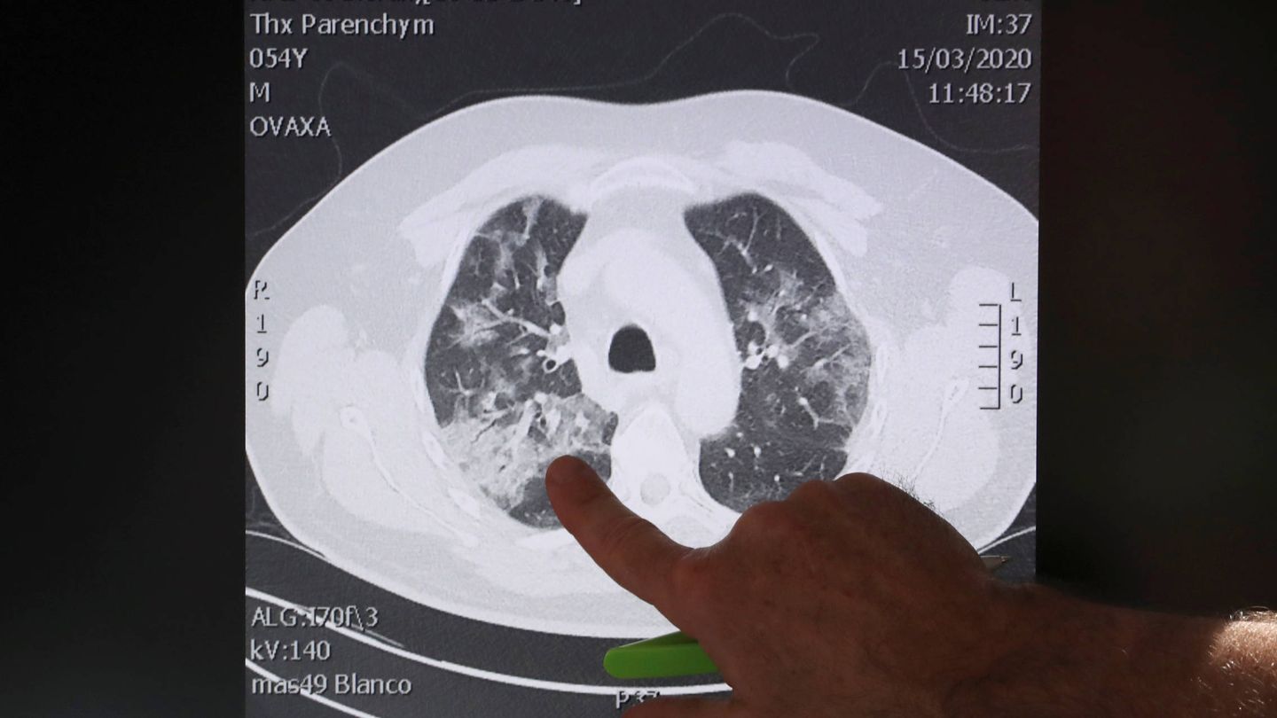 Un médico belga señala los pulmones de un paciente con covid-19 en el hospital belga de Aalst. (Reuters)
