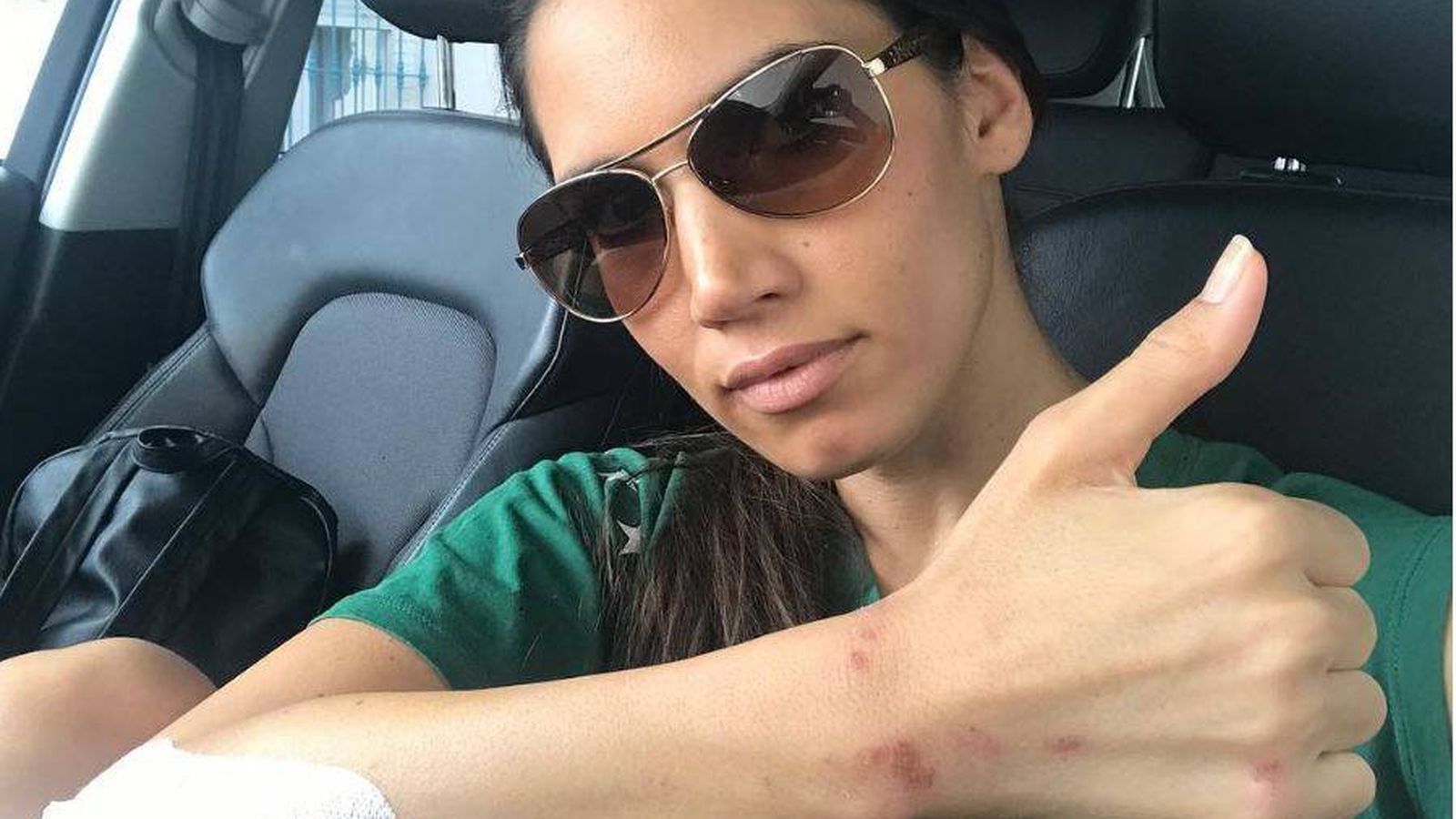 Foto: India Martínez muestra sus heridas. (Instagram)