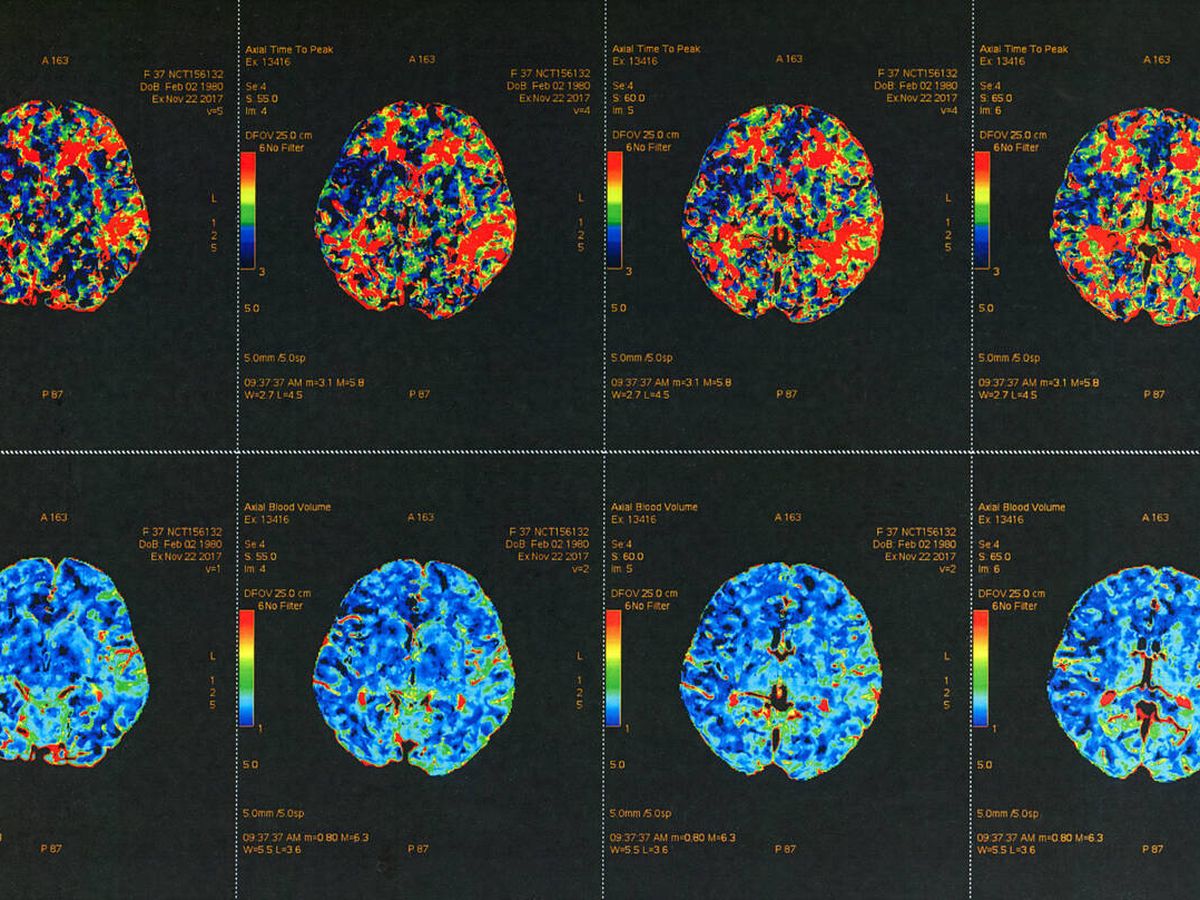 Foto: Resonancia magnética a color del cerebro humano. (iStock)