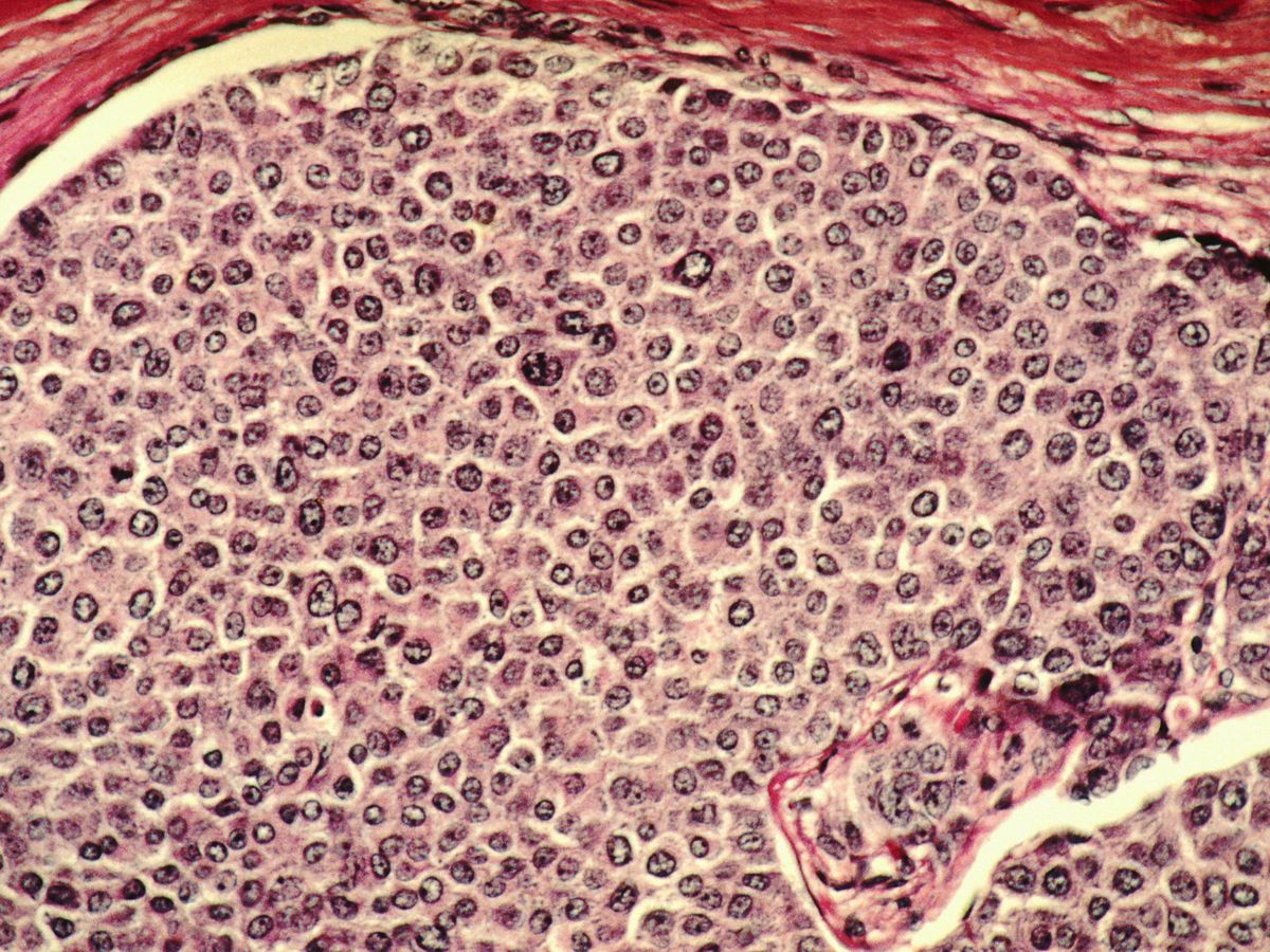 Foto: Células cancerígenas de cáncer de mama vistas al microscopio (Corbis)