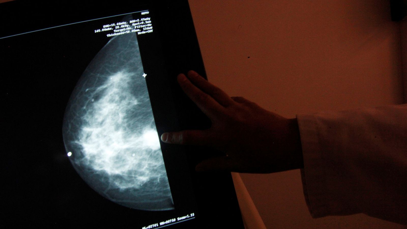 Foto: Una pantalla muestra un cáncer de mama en México DF. (Edgar Garrido / Reuters)