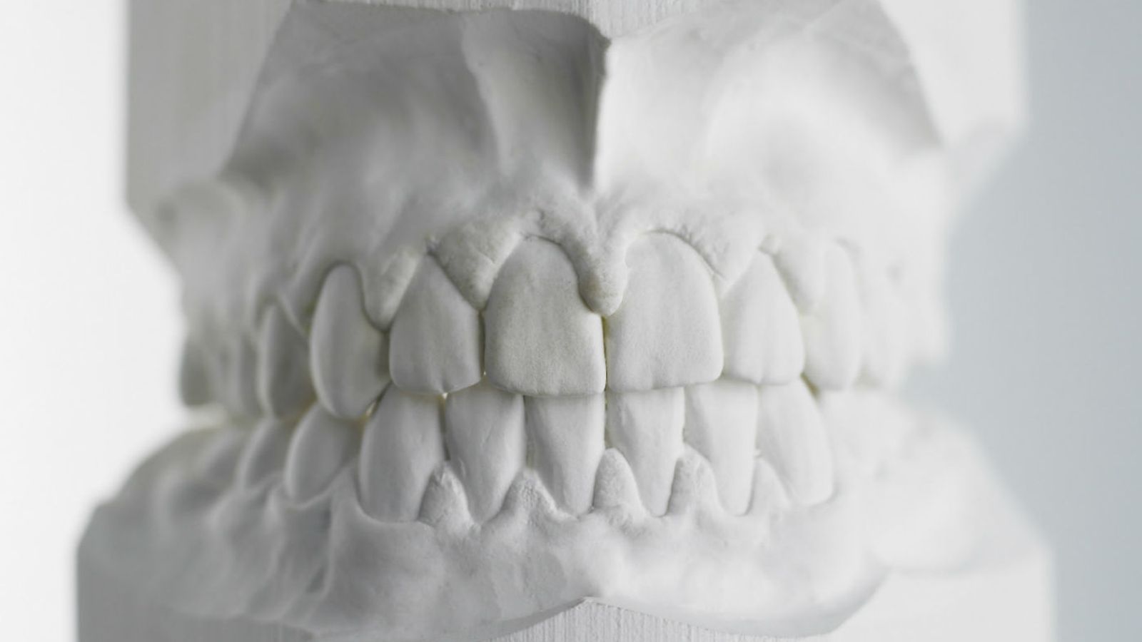 Foto: Molde de yeso dental. (Corbis)