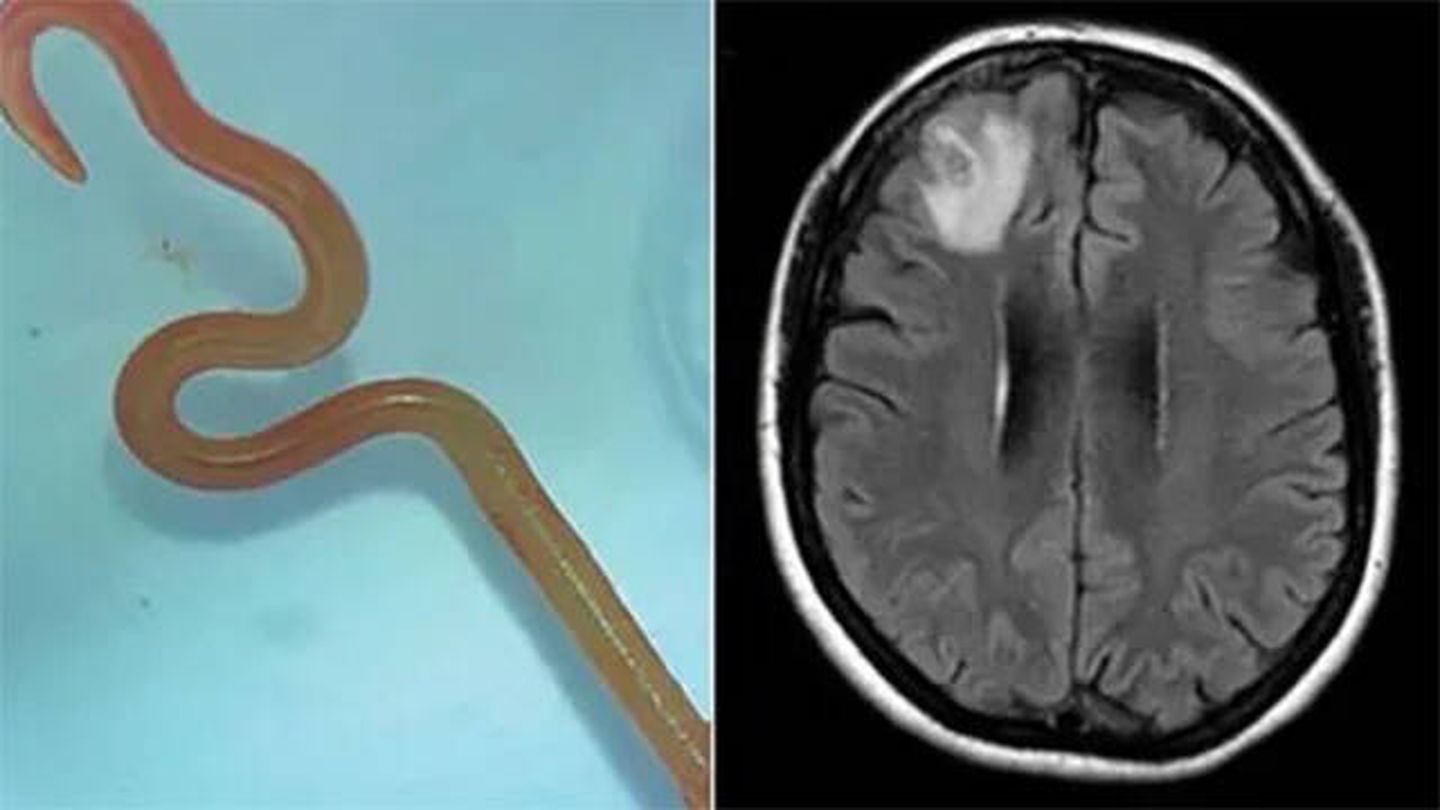 Fotografías del gusano extraído y resonancia cerebral de la paciente (Hospital de Camberra)