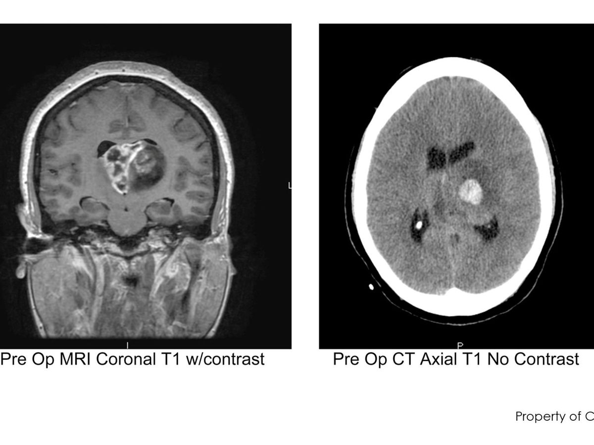 Foto: Imágenes de un glioblastoma cerebral. Foto: REUTERS