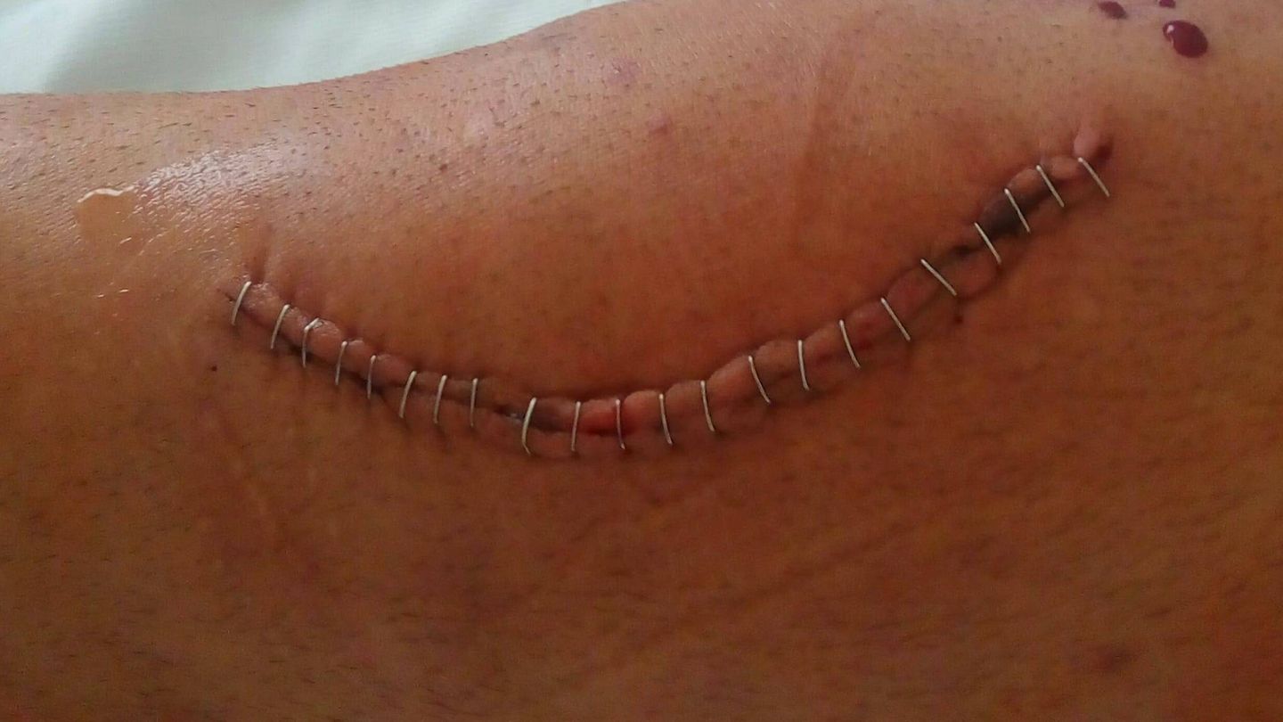Imagen de la rodilla de Alejandro después de una de las operaciones.