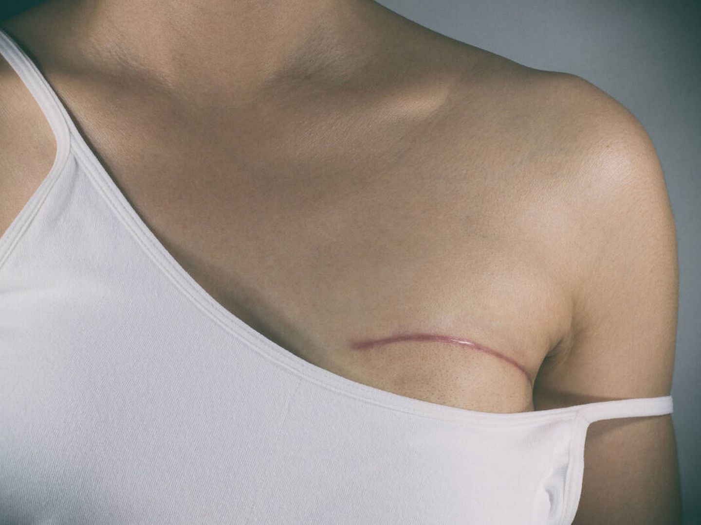 Las mastectomías han avanzado una barbaridad en 200 años. (iStock)
