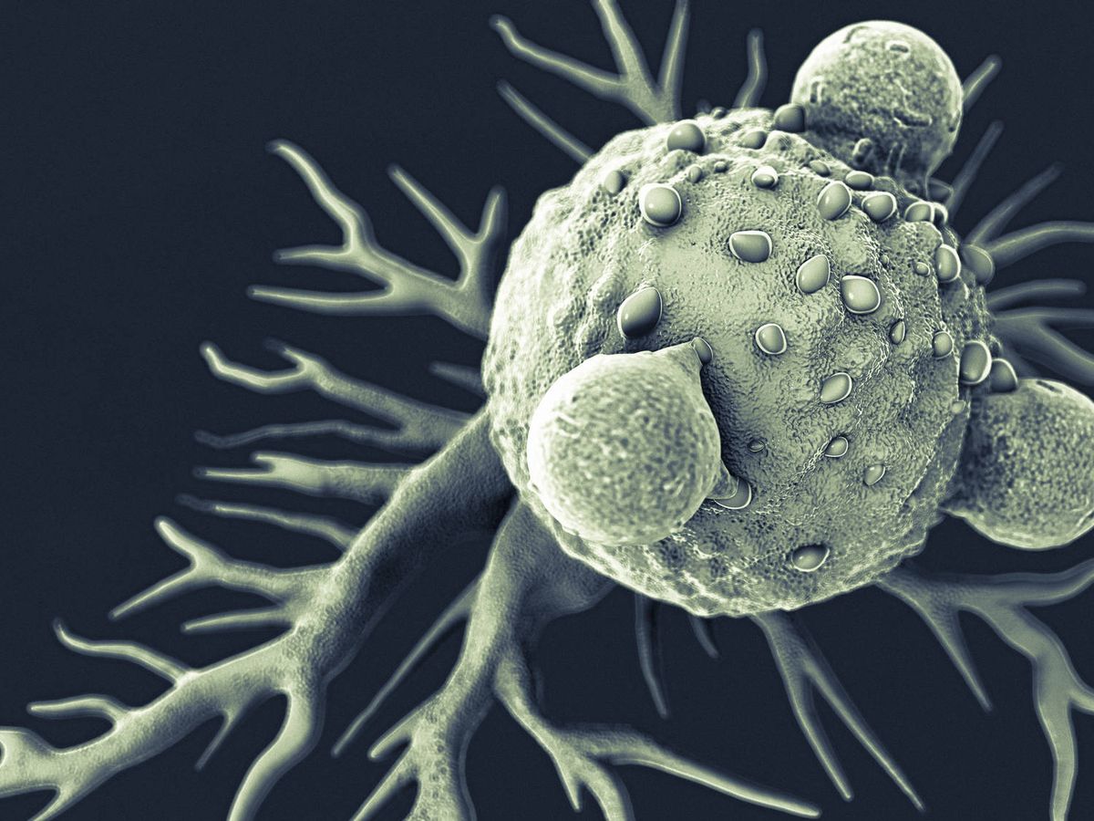 Foto: Una célula cancerosa con linfocitos T. (iStock)