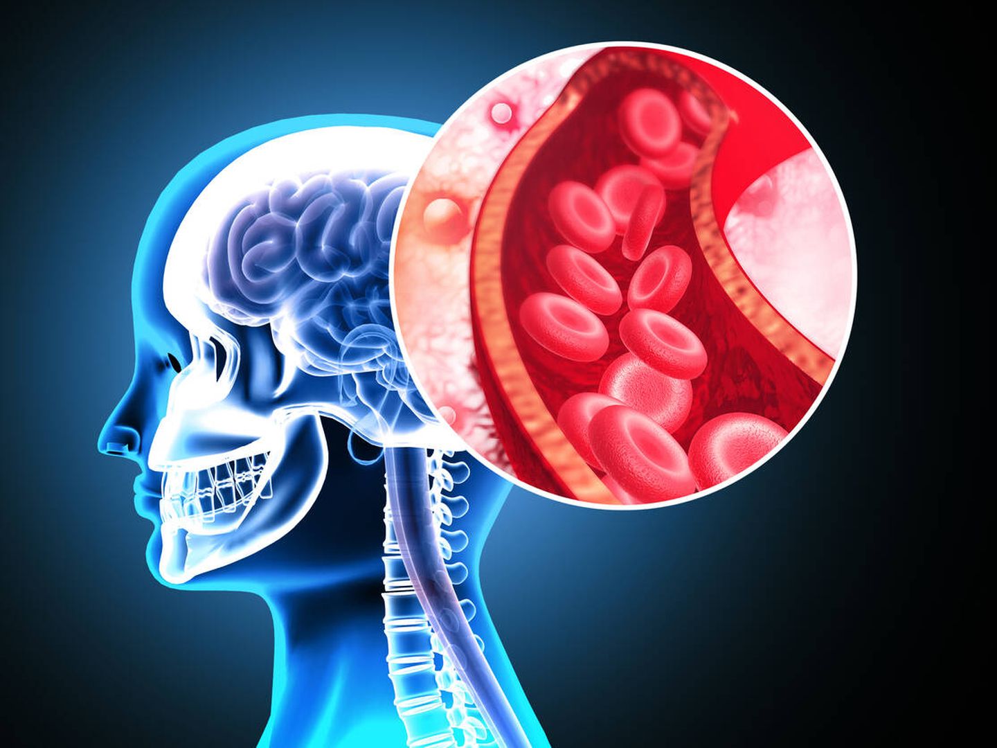 La falta de riego sanguíneo a una parte del cerebro provoca el ictus de origen isquémico. (iStock)