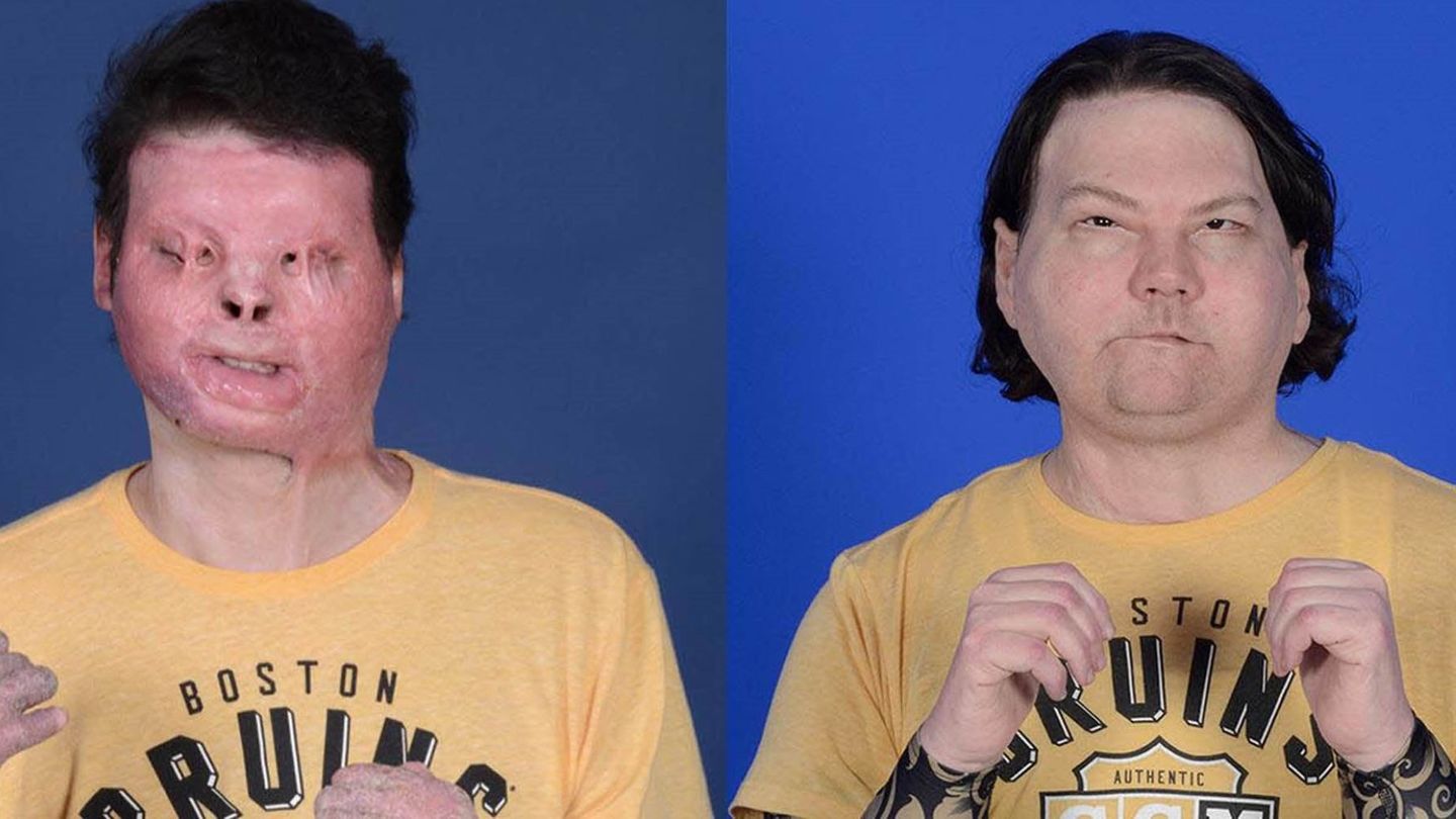 Composición de dos fotografías cedidas por el hospital NYU Langone de Nueva York donde se muestra el antes y después del trasplante de cara y de las dos manos a Joe DiMeo. (EFE/NYLangone)