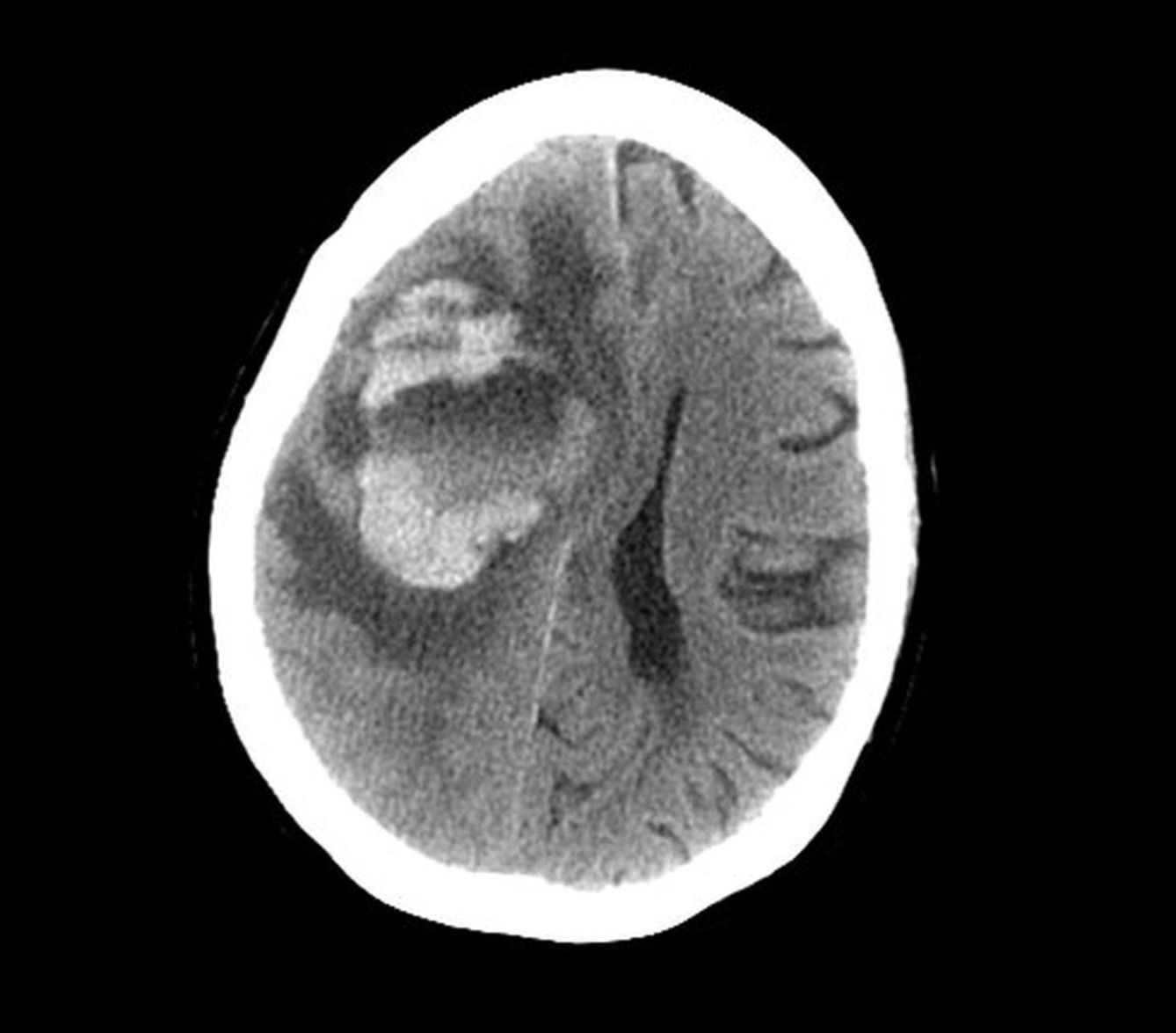 La infección de las amebas provocó una fuerte hemorragia en el cerebro. (Foto: Swedish Medical Center)