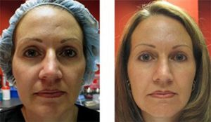 Tratamiento puntero de rejuvenecimiento facial