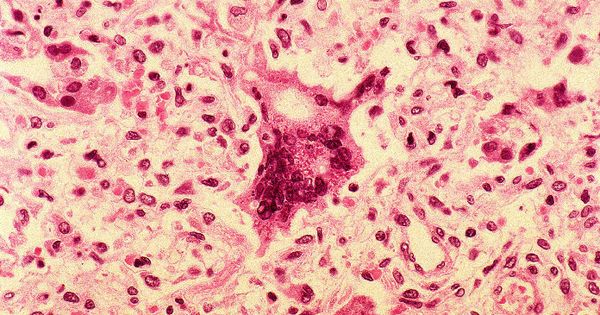 Foto: Células infectadas por el sarampión. (CDC/ Edwin P. Ewing, Jr)
