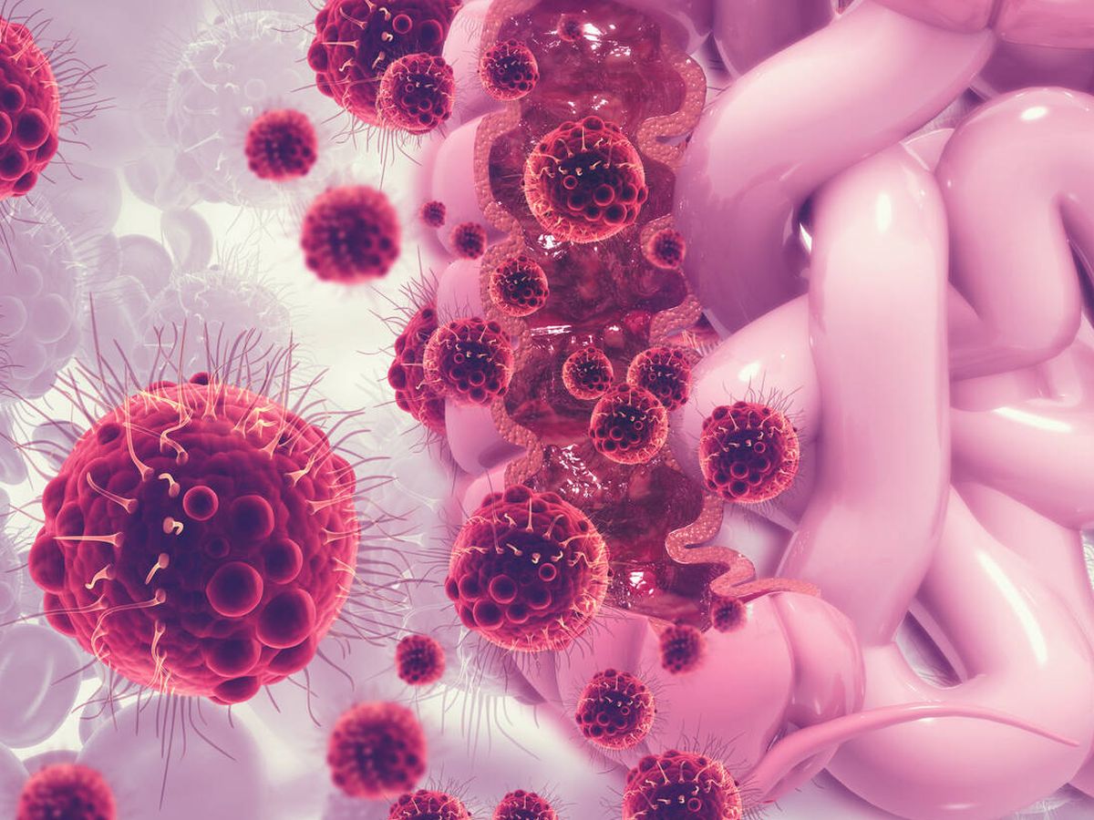 Foto: Imagen 3D de células cancerosas en el colon. (iStock)