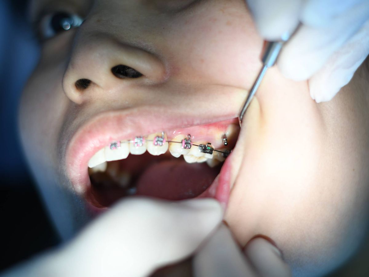 Foto: Las clásicas ortodoncias con 'brackets' van camino de la obsolescencia. (EFE)