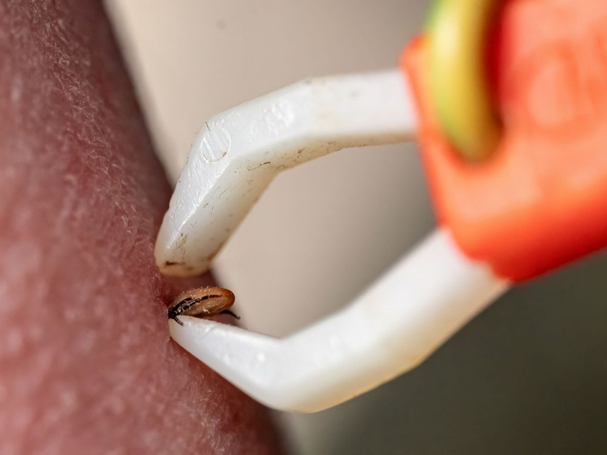 Foto: Una persona utiliza unas pequeñas pinzas para extraer de su piel a una garrapada. (EFE/Christian Bruna)