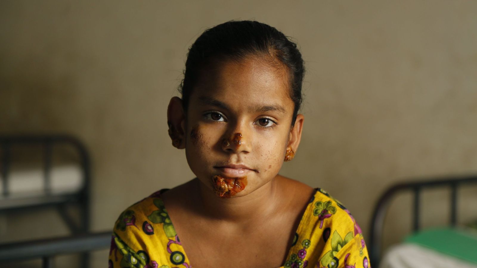 Foto: Shahana Khatun, una niña de 10 años de Bangladesh que sufre el síndrome del hombre árbol (Reuters)