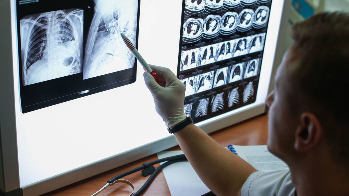 Investigadores españoles lideran una nueva terapia contra el cáncer de pulmón más agresivo