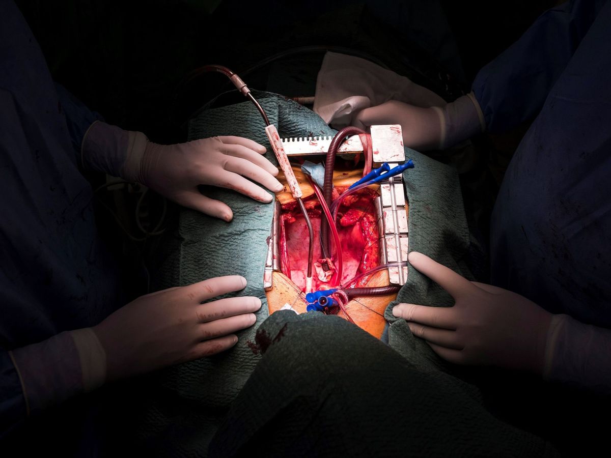 Foto: Una operación de trasplante de corazón.
