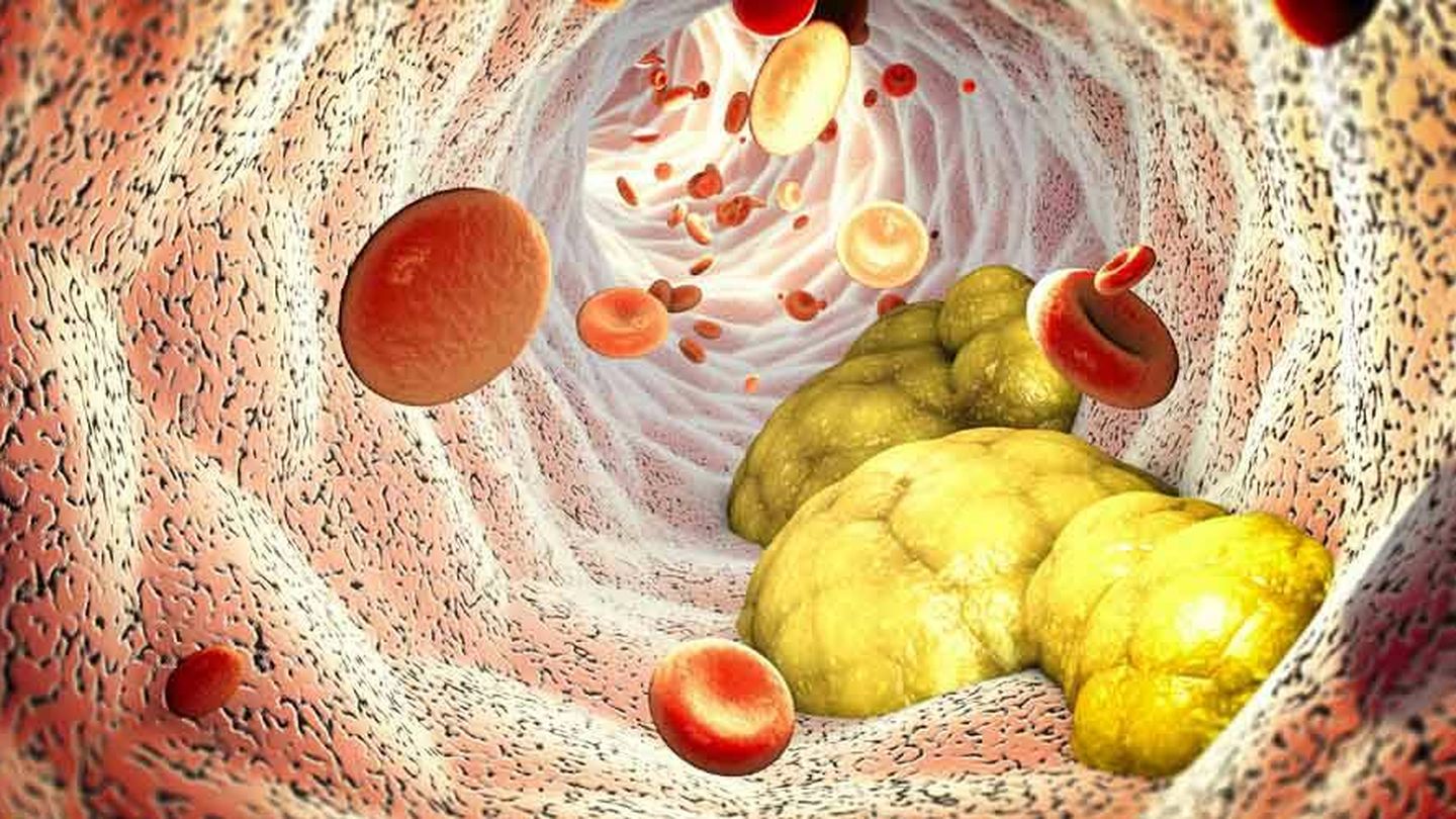 Los niveles altos de colesterol en sangre provocan la formación de placas de ateroma. (iStock)