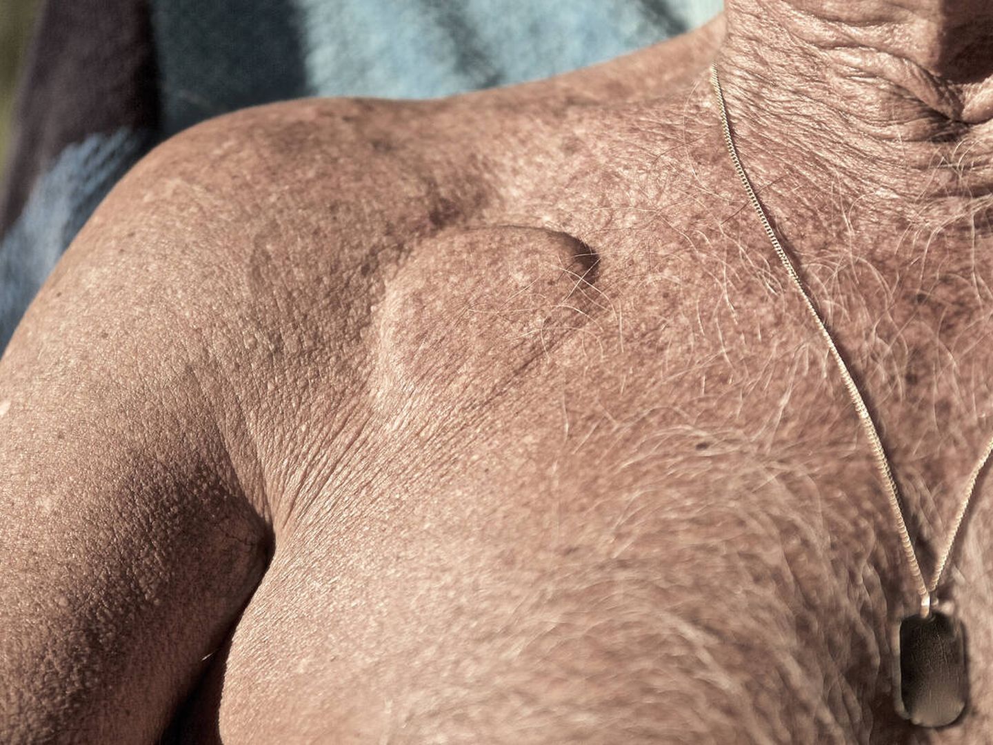 Marcapasos implantado en el pecho de un hombre. (iStock)
