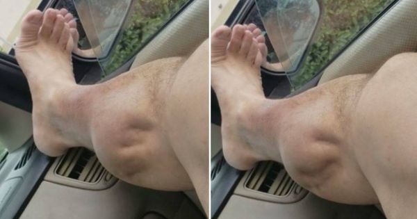 Foto: Imagen de la pierna de Ángel. (Youtube)