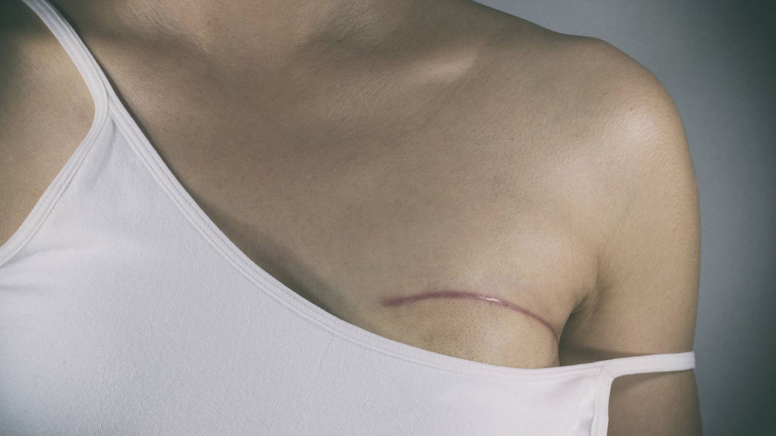 Foto: Una mujer enferma de cáncer de mama tras ser intervenida. (iStock)