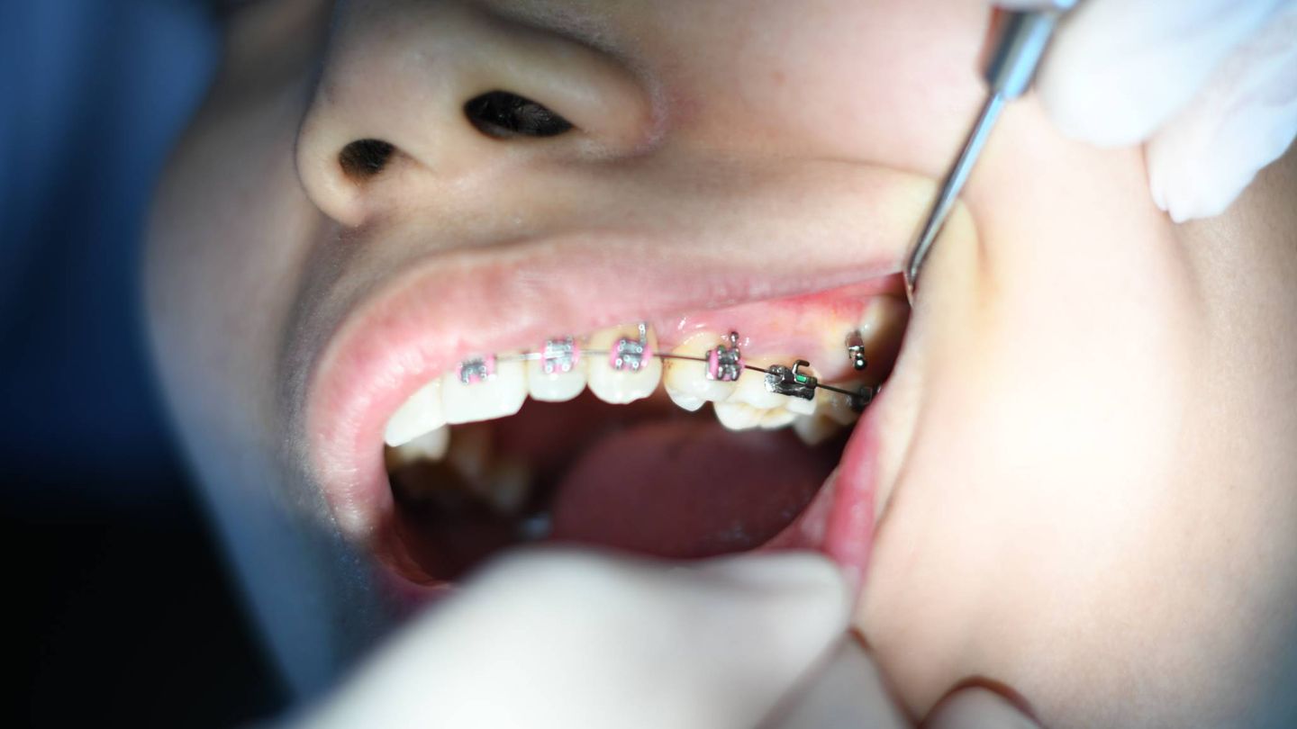 Las ortodoncias con brackets metálicos han aumentado un 70% este último año. (Unsplash)
