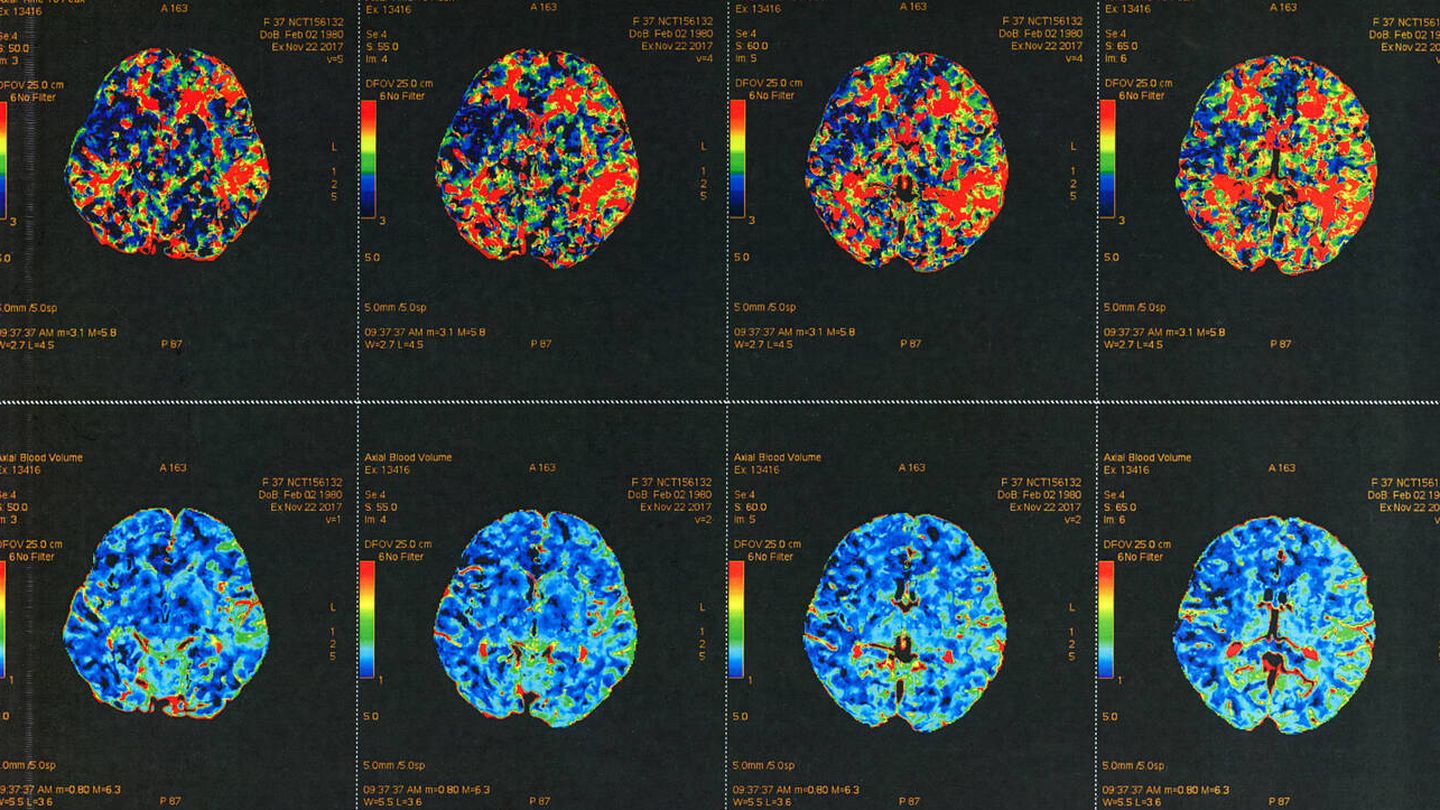 Imágenes de resonancia magnética del cerebro. (iStock)