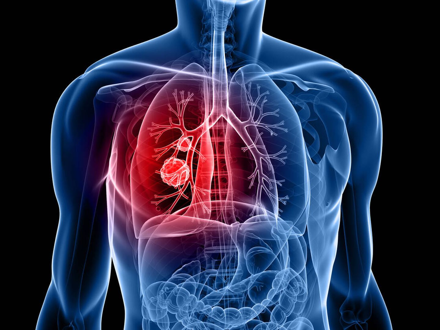 Cuando se encuentra un nódulo pulmonar hay que hacer pruebas más exhaustivas. (iStock)