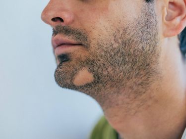 Alopecia Areata Origen Duraci N Y Soluci N De Las Calvas En La Barba