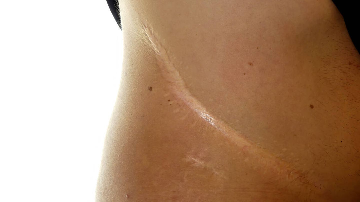 Cicatriz de un trasplante de riñón. (iStock)