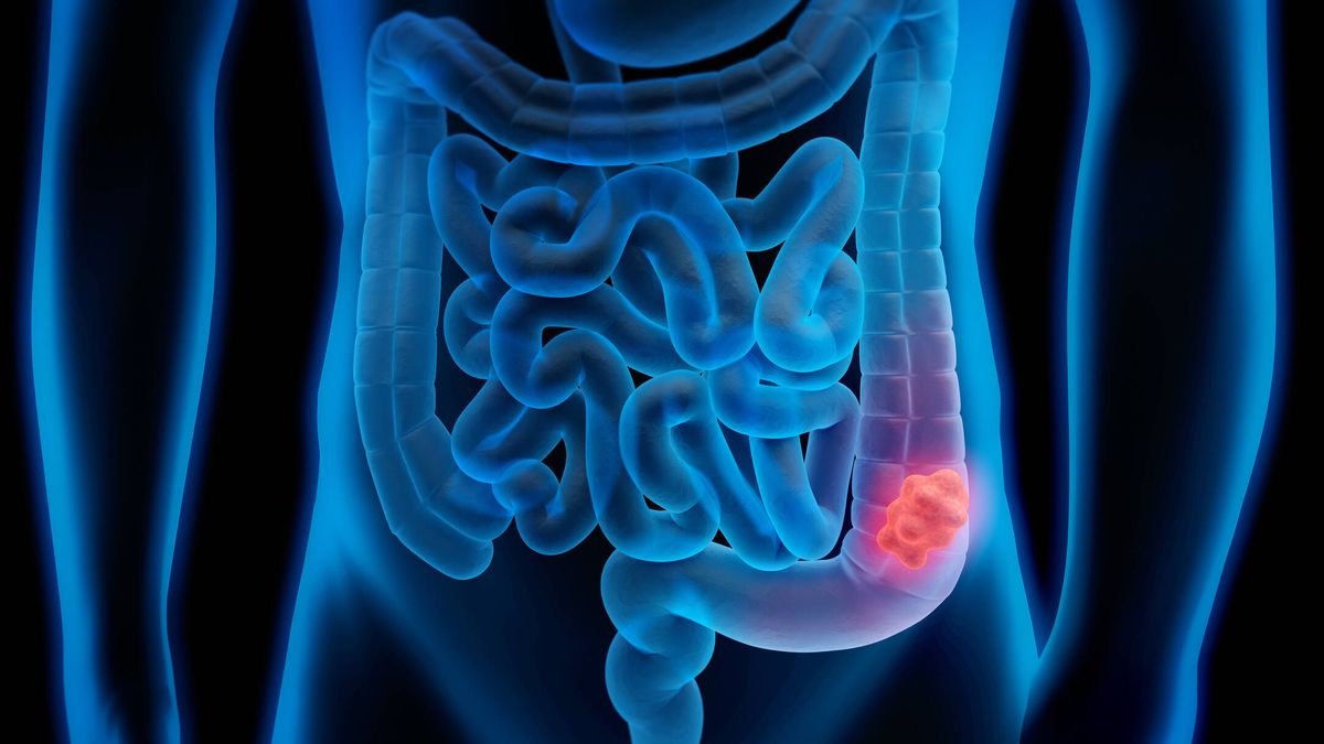 El nuevo test para detectar el cáncer de colon: menos invasivo y más barato