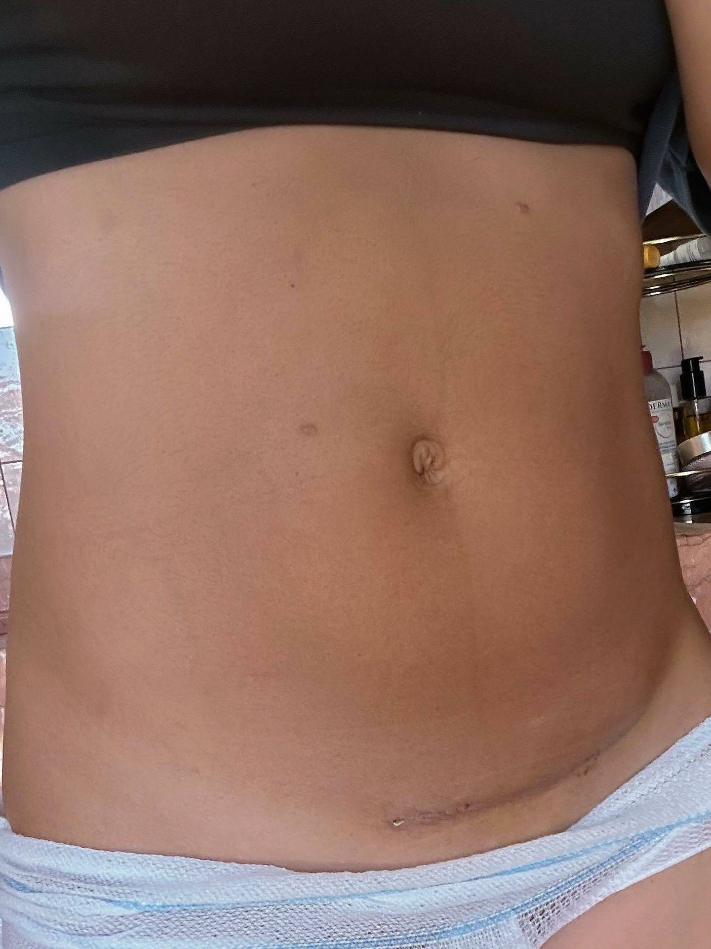 María Pombo muestra la cicatriz de su cesárea. (Instagram/@mariapombo)