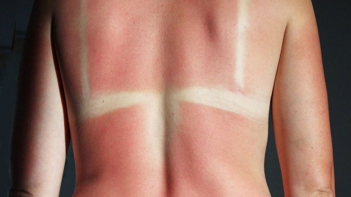 Cómo curar las quemaduras del sol y prevenir el cáncer, según un dermatólogo
