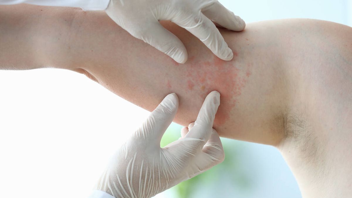 La revolución en marcha del tratamiento de la dermatitis (o eccema)