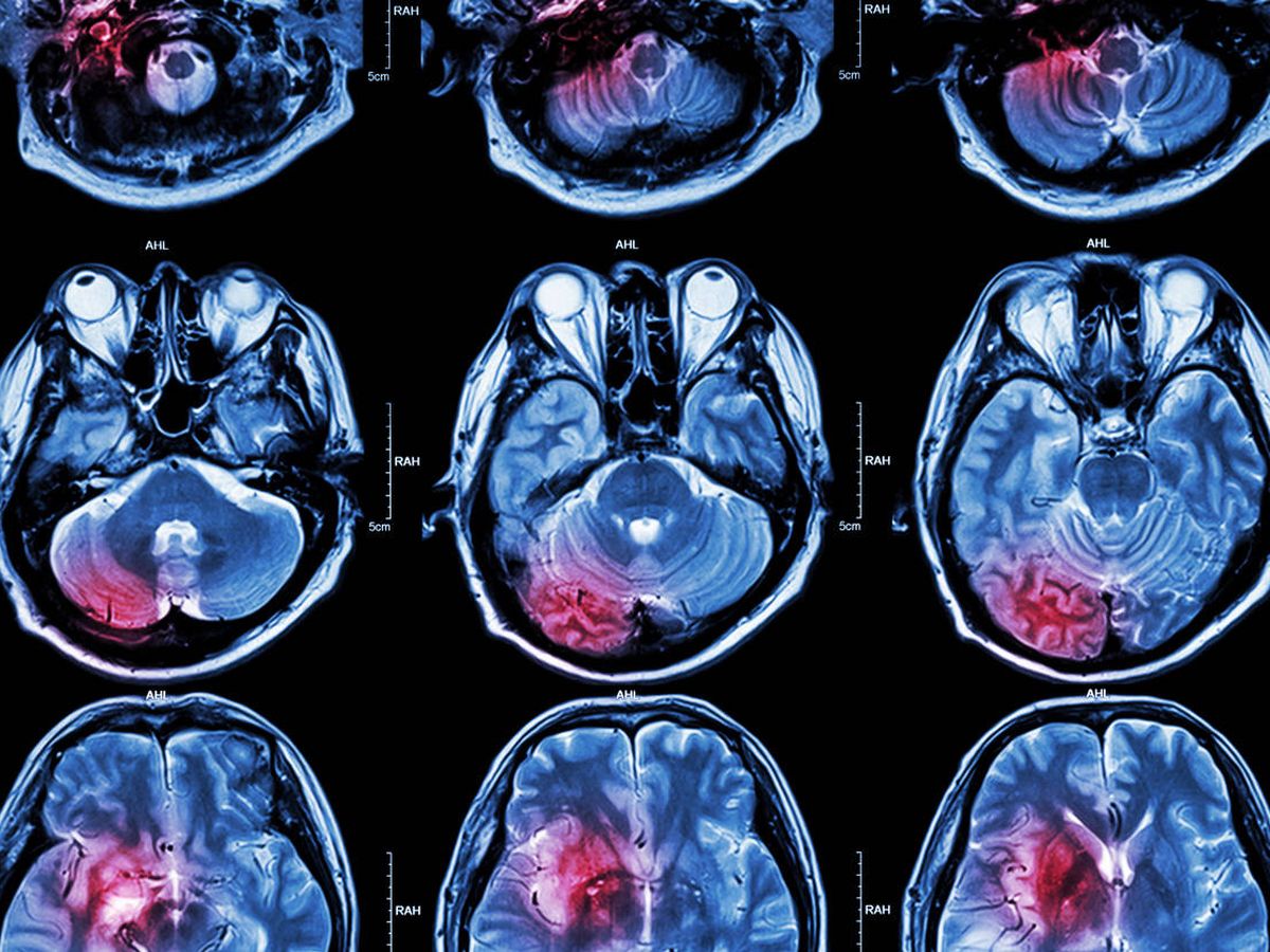 Foto: Resonancia magnética de un cerebro