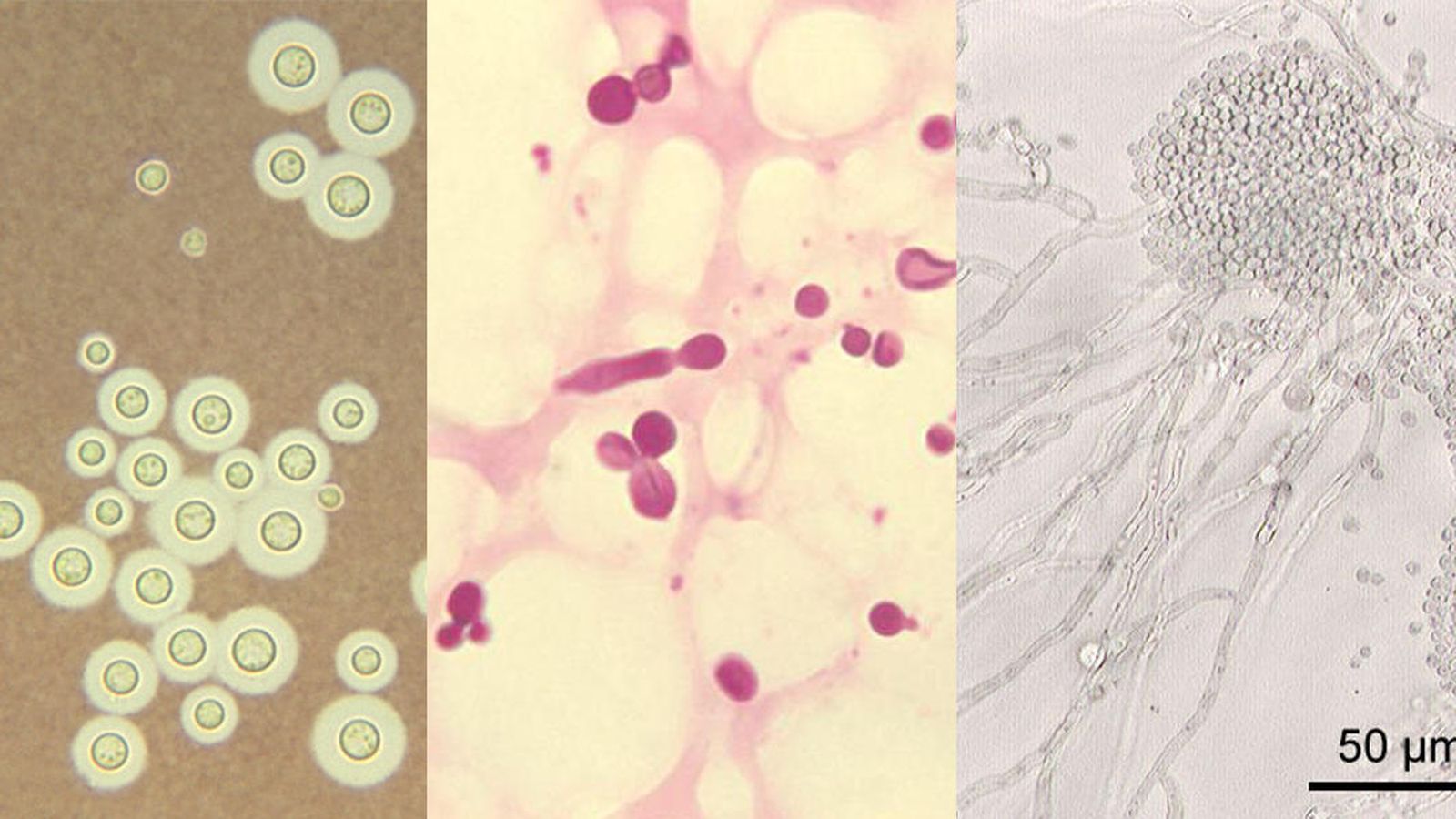 Foto: 'Cryptococcus spp'. y 'Malasezzia spp' y 'Candida albicans', los tres hongos que podrían estar relacionados con la ELA. (Creative Commons)