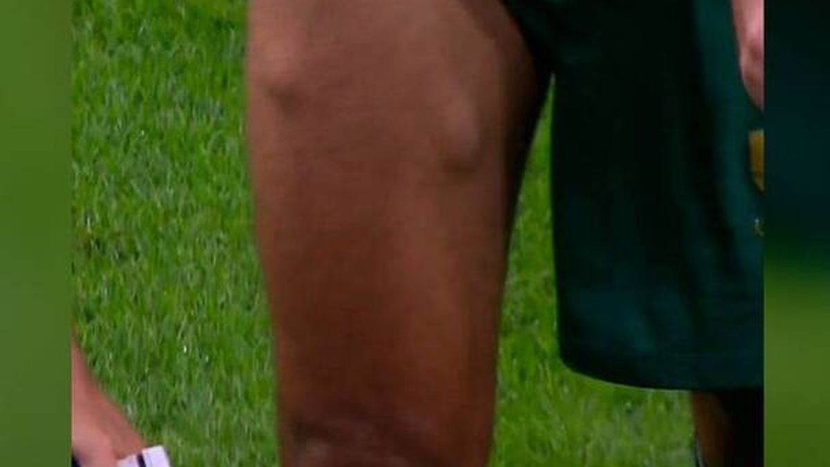 La sorprendente imagen de Fali en el Atlético - Cádiz: ¿por qué tiene bultos en la pierna?