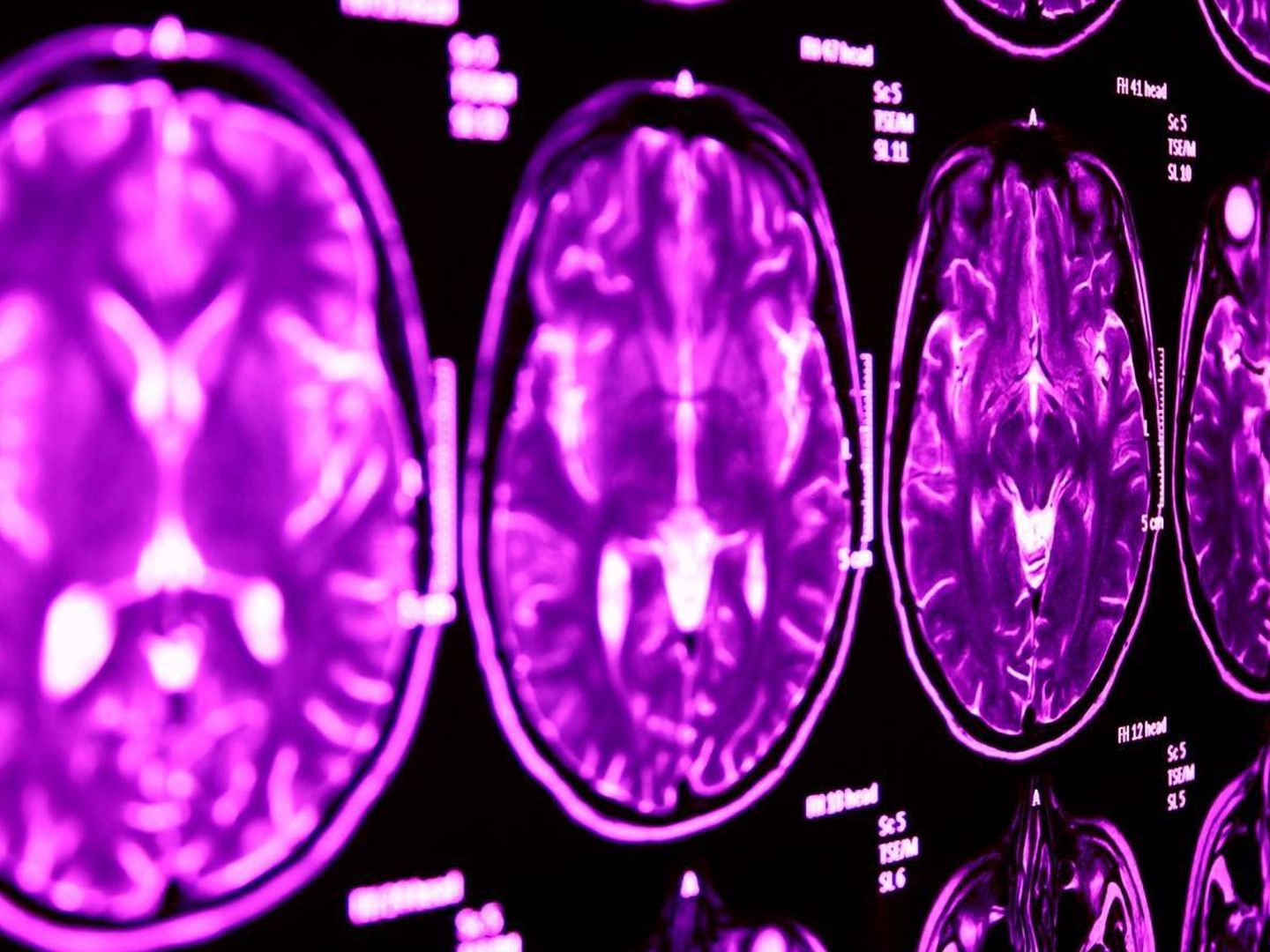 Resonancia magnética cerebral. Foto: Lancaster University